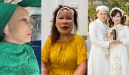 Cô dâu Thu Sao lại đại phẫu 'dao kéo', gương mặt băng bó sưng phù