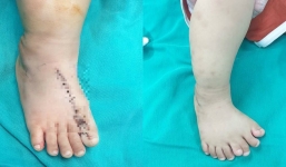 Kỳ lạ cậu bé 11 tháng tuổi ở Thanh Hóa có đến 9 ngón trên 1 bàn chân