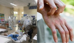 Bác sĩ liệt kê 5 triệu chứng phổ biến trên da của bệnh nhân nhiễm Covid-19