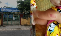 Bé gái 21 tháng tuổi ở Thái Bình bị cắn 12 vết tím người sau khi đi học buổi thứ 2