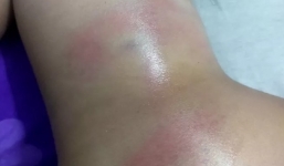 Bé gái 4 tuổi bị cô giáo đánh bầm tím, lý do đằng sau càng gây phẫn nộ