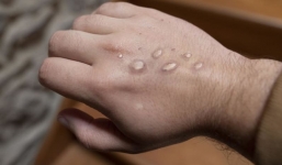 Đông Nam Á có ca nhiễm đậu mùa khỉ đầu tiên, nhà chức trách ráo riết truy vết tiếp xúc
