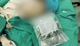 Bé gái 9 tuổi nuốt 1kg tóc vào bụng để thu hút sự chú ý của bố mẹ