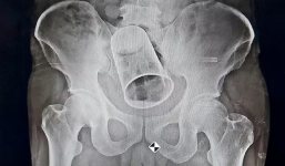 Phát hiện chiếc cốc thép khổng lồ trong trực tràng người đàn ông sau trò đùa tai quái của nhóm bạn