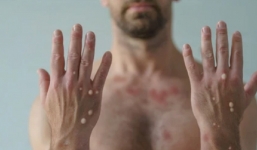 Chuyên gia chỉ rõ điểm khác biệt để phân biệt đậu mùa khỉ và thủy đậu