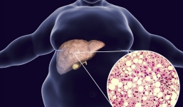 3 dấu hiệu báo động của bệnh gan nhiễm mỡ