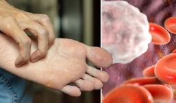 Xuất hiện 4 bệnh ngoài da này đi làm xét nghiệm máu ngay, cẩn thận tim mạch đang cầu cứu