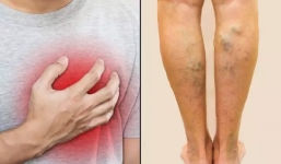 Chân sưng phù đột ngột không rõ nguyên nhân, đi khám ngay trước khi căn bệnh thầm lặng này chuyển biến nặng