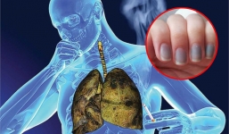 Bàn tay mà xuất hiện 4 dấu hiệu này chứng tỏ phổi đang rất yếu, cần can thiệp kịp thời