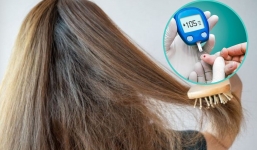 Triệu chứng thầm lặng của bệnh tiểu đường mà bạn có thể phát hiện khi chải đầu