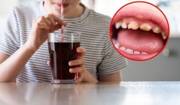 Đừng đổ lỗi cho đồ ăn thức uống, đây mới là thói quen bào mòn răng tệ nhất, rất nhiều người mắc phải