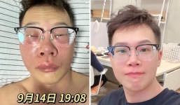 Người đàn ông 33 tuổi sưng phù mặt mũi vì thói quen ngoáy mũi, bác sĩ cảnh báo gay gắt