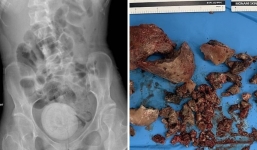 Phát hiện viên sỏi to bằng quả cam trong bụng người phụ nữ, bác sĩ đưa ra cảnh báo khiến ai cũng giật mình