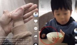 Hình ảnh cặp mẹ con đều bị mất một tay vì tai nạn khiến nhiều người xót xa