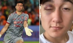 Đặng Văn Lâm tím bầm một bên mắt, CĐV Thái xót xa chúc anh sớm bình phục 
