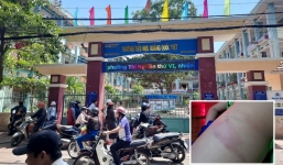 Phụ huynh tung ảnh lên mạng xã hội, tố cáo giáo viên chủ nhiệm đánh bầm tím học sinh lớp 3