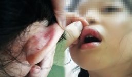 Phụ huynh tố giáo viên chủ nhiệm dùng sách đánh học sinh bầm môi, tụ máu 