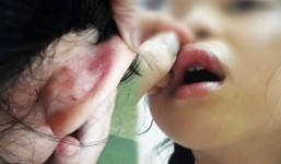 Vụ phụ huynh tố học sinh bị đánh bầm môi, tụ máu: Giáo viên muốn đòi lại công bằng