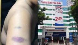 Giáo viên trường Quốc tế Á châu bị phụ huynh tố đánh bầm tím tay học sinh