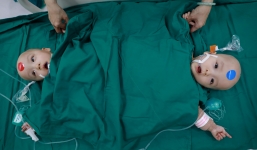 Hai bé song sinh đã hồi tỉnh sau hơn 12 giờ phẫu thuật, bác sĩ tiết lộ tình hình hiện tại