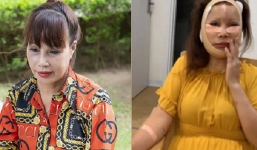 Cô dâu 62 tuổi lần đầu công khai khuôn mặt bị méo thậm tệ sau thẩm mỹ: Biết vậy tôi đã không làm