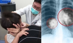 Bố hút vài chục điếu thuốc mỗi ngày: Con 5 tuổi nhập viện vì huyết áp cao, mạch máu xơ cứng