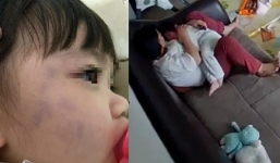 Đi làm về thấy con gái thâm tím hai má, mẹ kiểm tra camera mới thấy hành động đáng phẫn nộ của giúp việc 