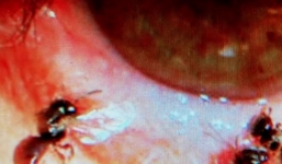 Người phụ nữ suýt mất nhãn cầu vì 4 con ong làm tổ trong mắt