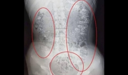 Bé gái Trung Quốc đau bụng suốt 5 ngày vì hàng trăm viên trân châu trong bụng