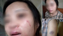 Mua giày online, thai phụ 8 tháng bị chồng đánh bầm người, đuổi về nhà đẻ