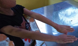 Bé 9 tuổi bị cô giáo dạy thêm đánh tím tay vì tiếp thu chậm