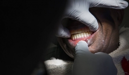 Đầu bếp tiêu tán sự nghiệp sau một lần nhổ răng khôn