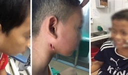 Phát hiện 3 trẻ nhiễm vi khuẩn 'ăn thịt người' ở Nghệ An