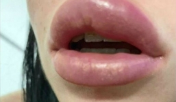 Nuốt phải dung dịch do bơm môi bị vỡ, người phụ nữ suýt bị mù