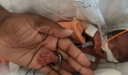 Bé gái chào đời nhỏ hơn búp bê Barbie hồi phục kỳ diệu