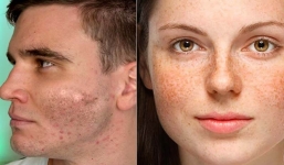 5 sản phẩm đẩy lùi tàn nhang thực sự hiệu quả