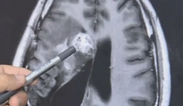 Phát hiện sán dây dài 12 cm ăn não người đàn ông suốt 15 năm