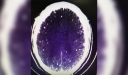 Ăn thịt lợn chưa nấu chín kỹ, người đàn ông co giật như động kinh