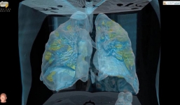 Cận cảnh quá trình Covid-19 tấn công và phá hủy phổi bệnh nhân