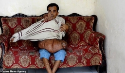 Khao khát của người đàn ông mang khối u khổng lồ 40kg trên mặt