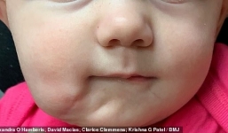 Bé gái có 2 miệng: Căn bệnh cực hiếm cả thế giới có 35 người mắc