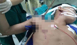 Cứu nam công nhân bị thanh sắt đâm thấu nách