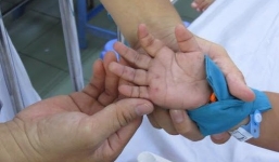 Hơn 10.000 ca tay chân miệng toàn quốc, Bộ Y tế ra công văn khẩn