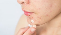 Cô gái nguy kịch vì nặn mụn ở 'tam giác tử thần'