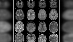 Phát hiện Covid-19 có thể xâm nhập trực tiếp vào não