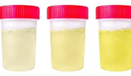 Nhìn màu nước tiểu đoán ngay bạn khỏe hay yếu