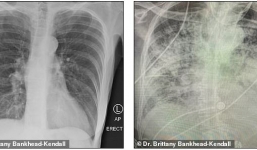 Phim X-quang lá phổi hậu Covid-19 khiến bác sĩ choáng váng