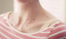 Cách nhận biết 'nốt ruồi xấu' để đi khám bác sĩ kịp thời