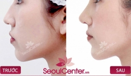 Nâng mũi Hàn Quốc: Xu hướng làm đẹp được nhiều người chú ý nhất