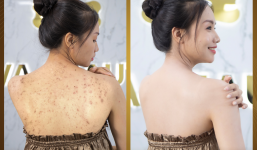 Trị viêm nang lông di truyền bằng công nghệ Ultra Skin tại Phòng khám da liễu AVA có hiệu quả không?